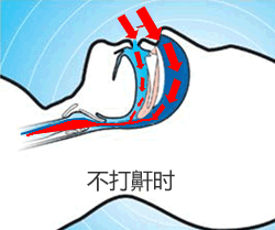 打鼾怎么治疗效果好?